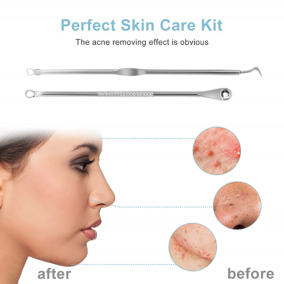 Stainless Steel Blackhead and Blemish Extractor Set